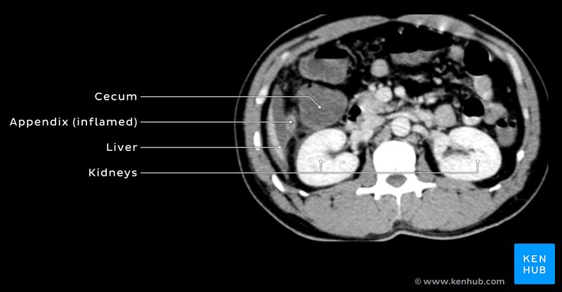 Axial CT of inflamed appendix