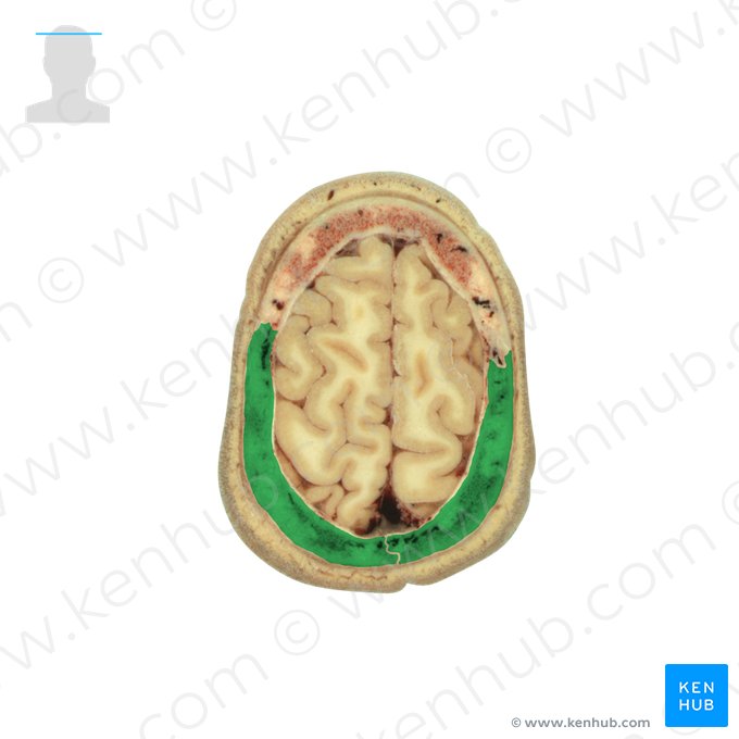 Osso parietal (Os parietale); Imagem: National Library of Medicine