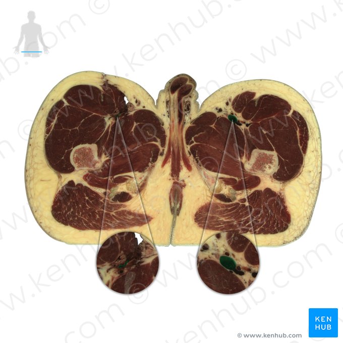 Femoral vein (Vena femoralis); Image: National Library of Medicine