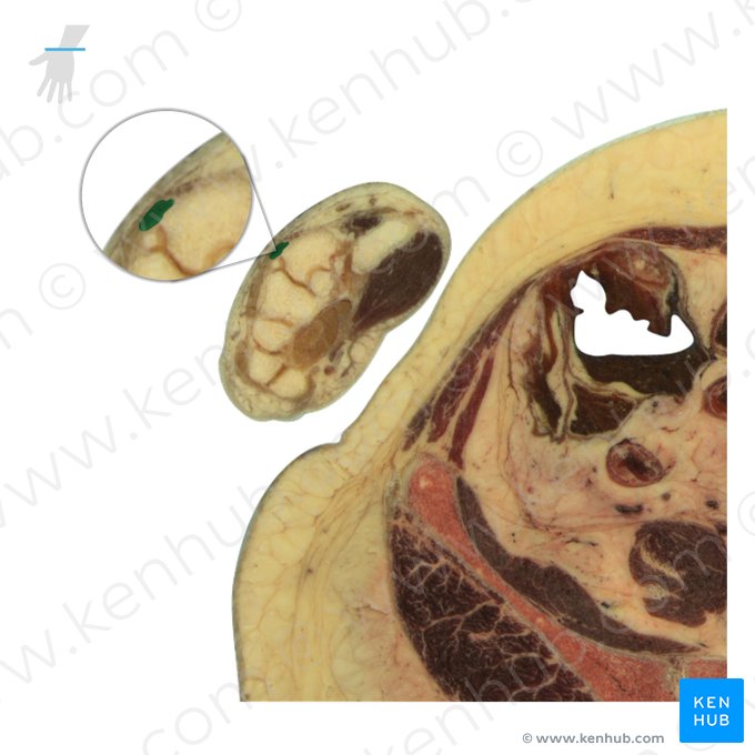 Tendon of extensor indicis muscle (Tendo musculi extensor indicis); Image: National Library of Medicine