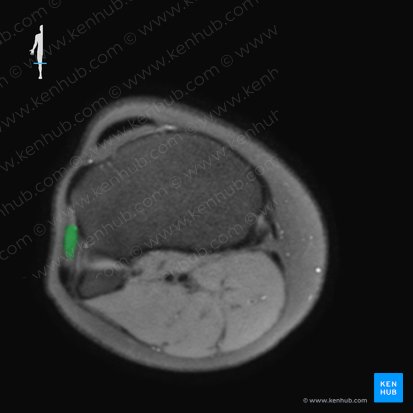 Musculus fibularis longus (Langer Wadenbeinmuskel); Bild: 
