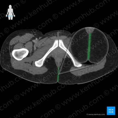 Intergluteal cleft (Crena interglutealis); Image: 