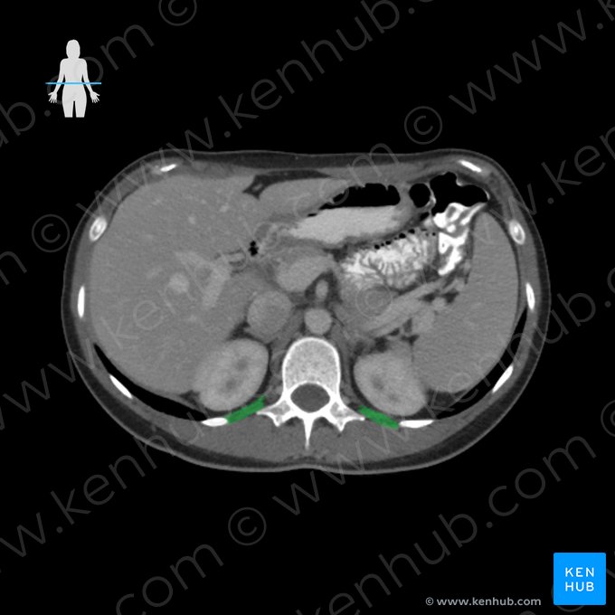 Musculus quadratus lumborum (Viereckiger Lendenmuskel); Bild: 