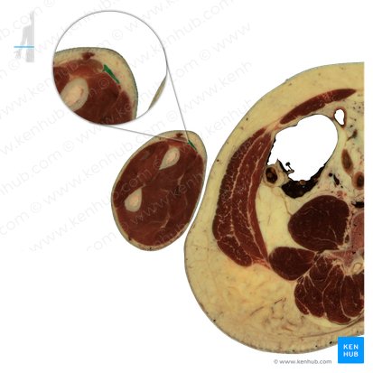 Musculus brachioradialis (Oberarm-Speichen-Muskel); Bild: National Library of Medicine