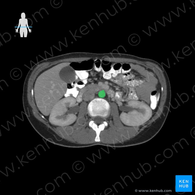 Aorta abdominal (Aorta abdominalis); Imagen: 