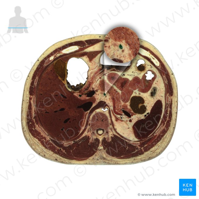 Left gastric vein (Vena gastrica sinistra); Image: National Library of Medicine