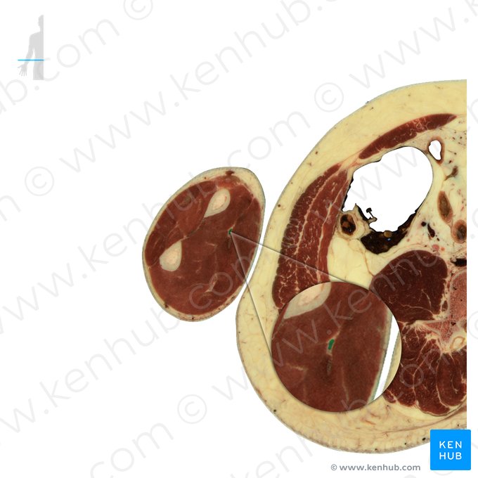 Nervo mediano (Nervus medianus); Imagem: National Library of Medicine