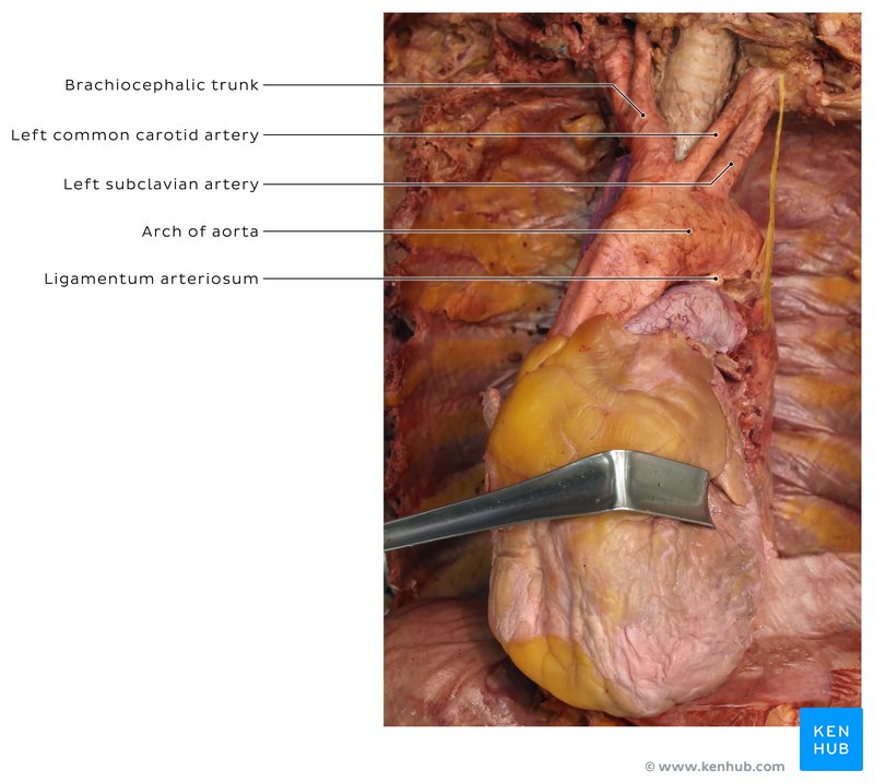 Aortic arch - anterior view