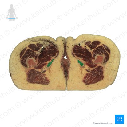 Tuberosidad del isquion (Tuber ischiadicum); Imagen: National Library of Medicine