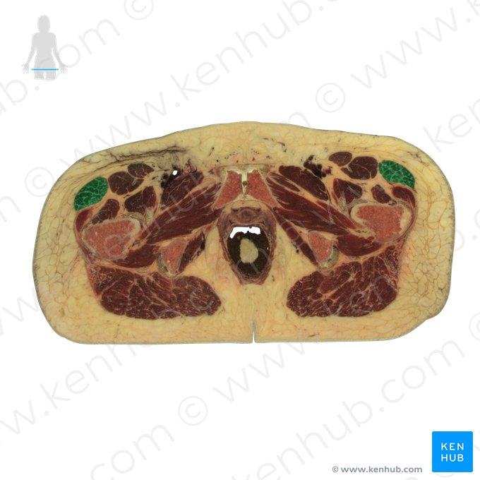 Músculo tensor da fáscia lata (Musculus tensor fasciae latae); Imagem: National Library of Medicine