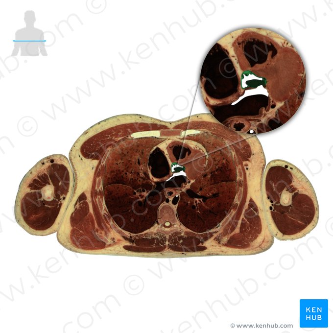 Aorta ascendens; Bild: National Library of Medicine