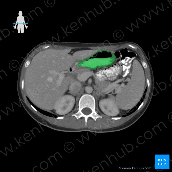 Cuerpo gástrico (Corpus gastris); Imagen: 