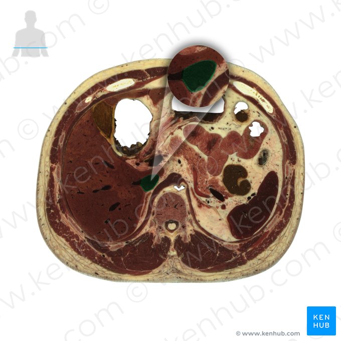 Veia cava inferior (Vena cava inferior); Imagem: National Library of Medicine