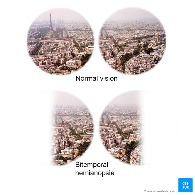 Visual fields in normal vision and bitemporal hemianopsia