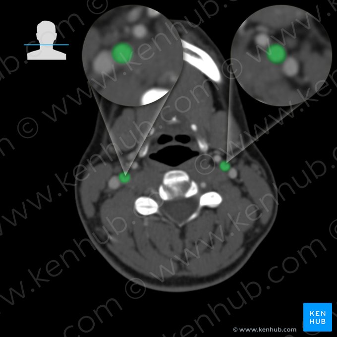 Arteria carótida interna (Arteria carotis interna); Imagen: 