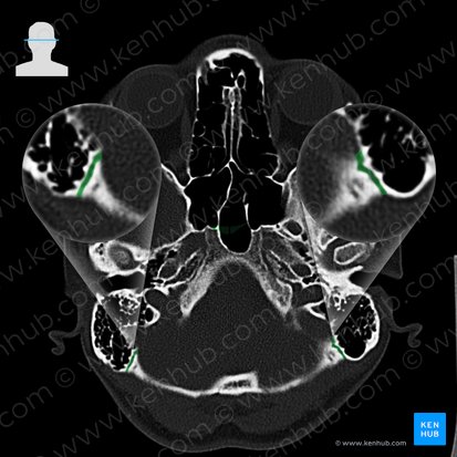 Occipitomastoid suture (Sutura occipitomastoidea); Image: 