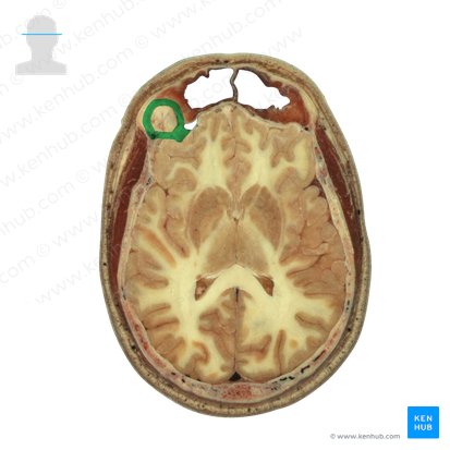 Facies superior laminae orbitalis ossis frontalis (Obere Fläche der Augenhöhlenplatte des Stirnbeins); Bild: National Library of Medicine