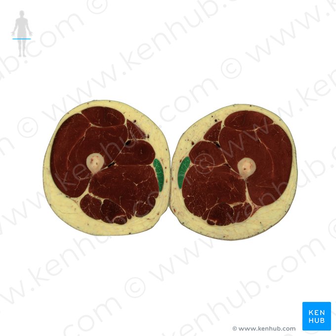 Músculo grácil (Musculus gracilis); Imagem: National Library of Medicine