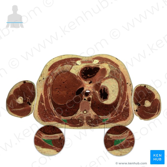 Musculus iliocostalis thoracis (Darmbein-Rippen-Muskel der Brust); Bild: National Library of Medicine