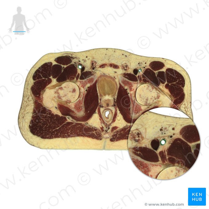 Artéria femoral (Arteria femoralis); Imagem: National Library of Medicine