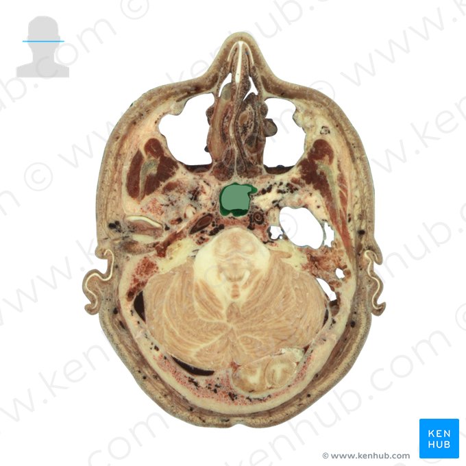 Seio esfenoidal (Sinus sphenoidalis); Imagem: National Library of Medicine