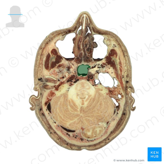 Sphenoidal sinus (Sinus sphenoidalis); Image: National Library of Medicine