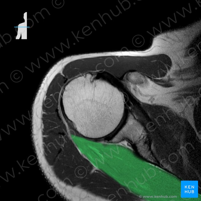 Musculus infraspinatus (Untergrätenmuskel); Bild: 