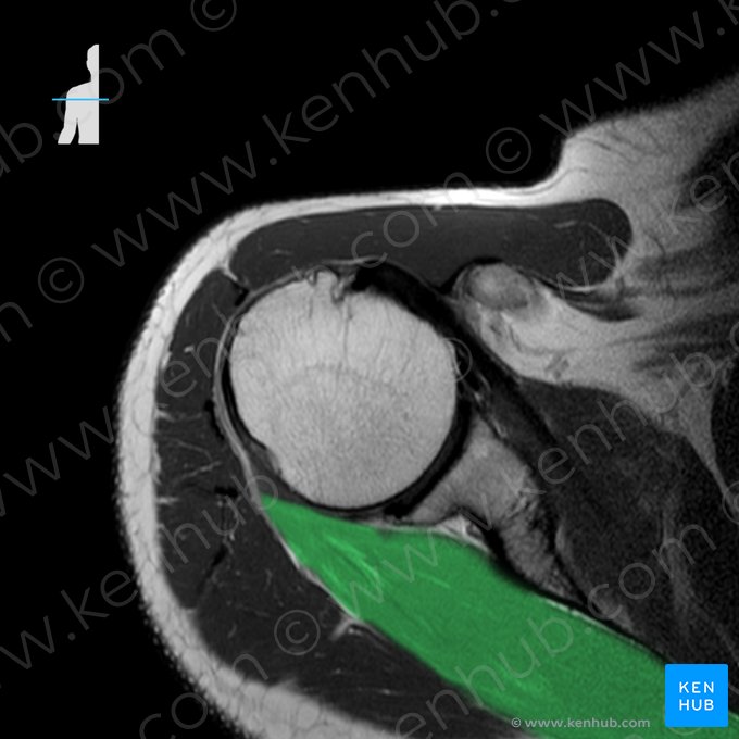 Músculo infraespinal (Musculus infraspinatus); Imagem: 