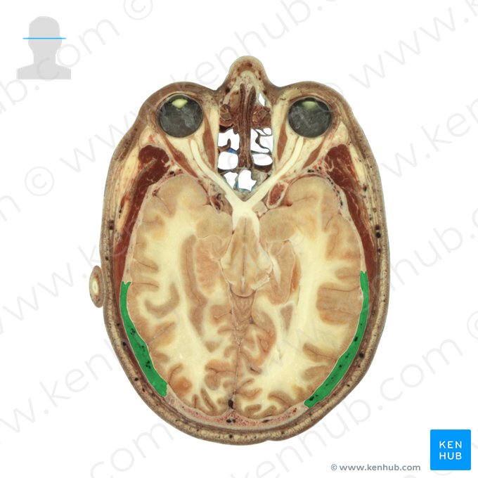 Parietal bone (Os parietale); Image: National Library of Medicine