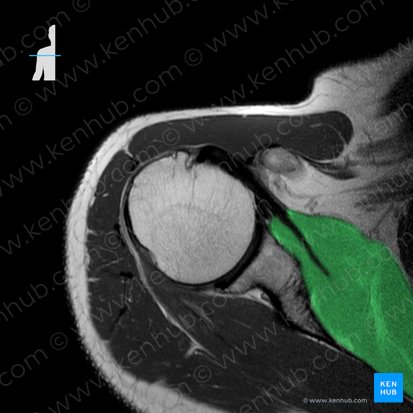 Subscapularis muscle (Musculus subscapularis); Image: 