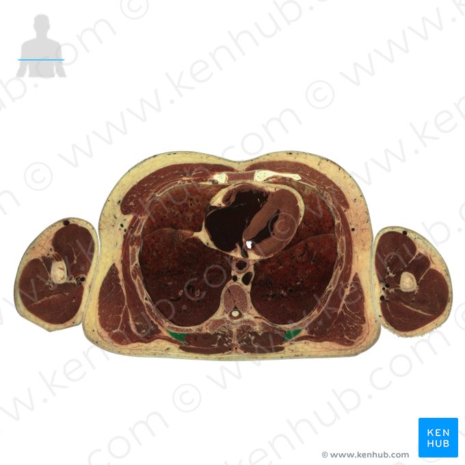 Músculo iliocostal do tórax (Musculus iliocostalis thoracis); Imagem: National Library of Medicine