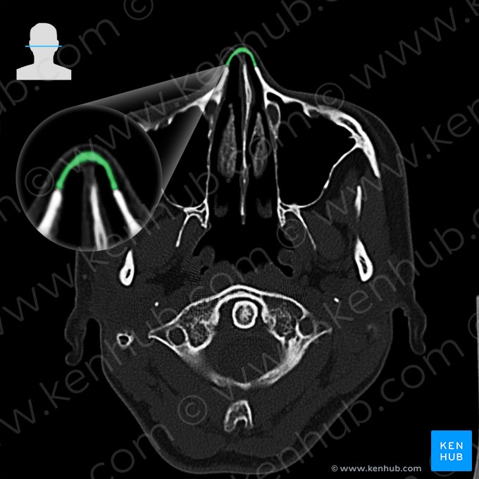 Hueso nasal (Os nasale); Imagen: 