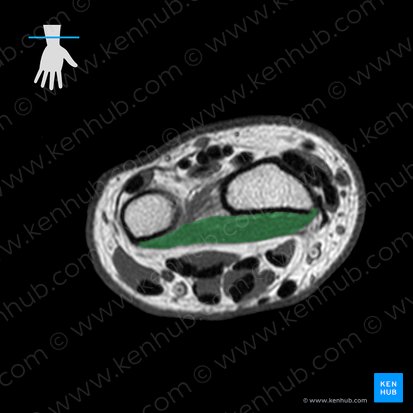 Pronator quadratus muscle (Musculus pronator quadratus); Image: 