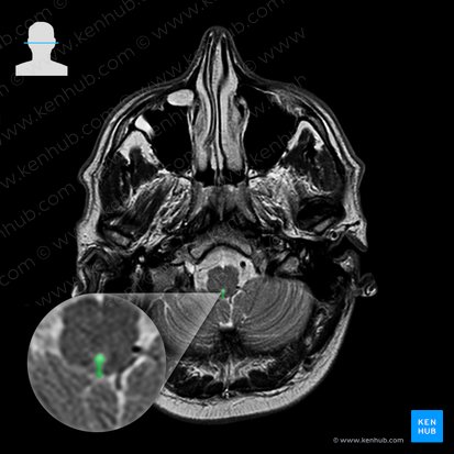 Abertura mediana do quarto ventrículo (Apertura mediana ventriculi quarti); Imagem: 