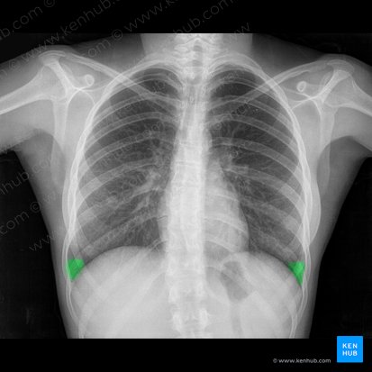 Costophrenic angle (Angulus costophrenicus); Image: 