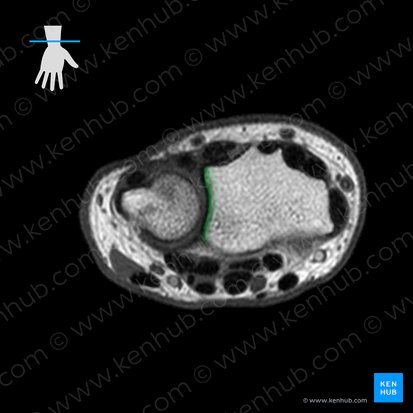 Incisure ulnaire du radius (Incisura ulnaris radii); Image : 