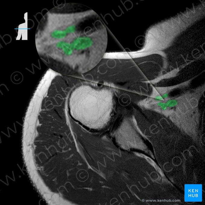 Plexus brachialis (Armgeflecht); Bild: 