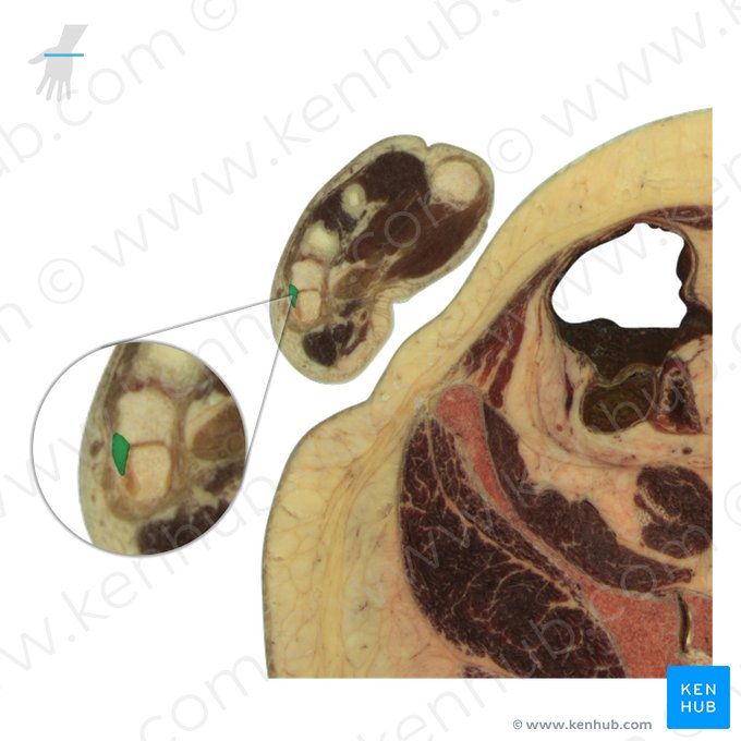 Hamate bone (Os hamatum); Image: National Library of Medicine