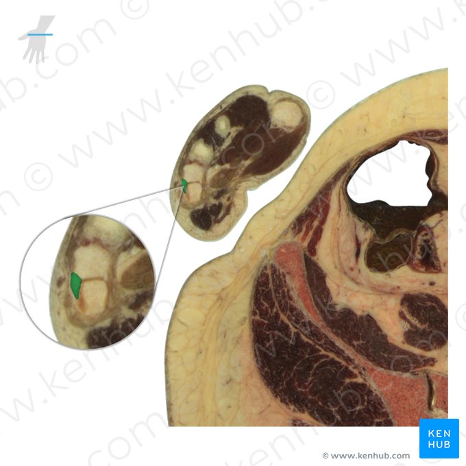 Osso hamato (Os hamatum); Imagem: National Library of Medicine