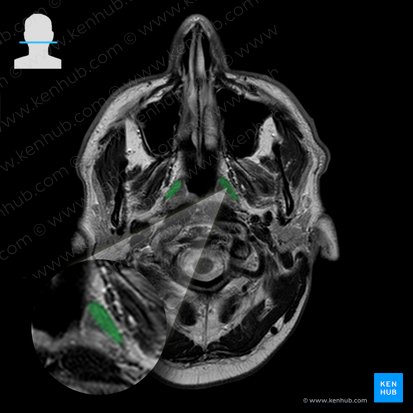 Musculus levator veli palatini (Gaumensegelheber); Bild: 