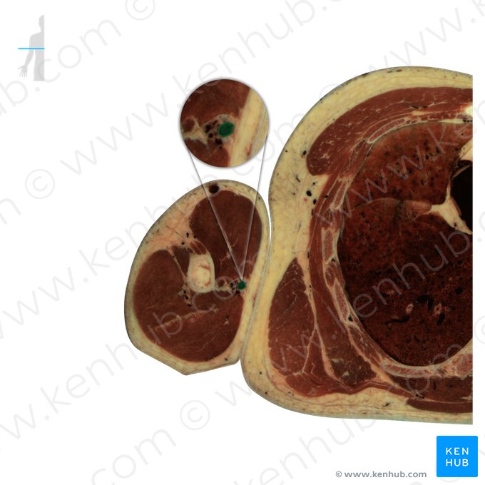 Basilic vein (Vena basilica); Image: National Library of Medicine