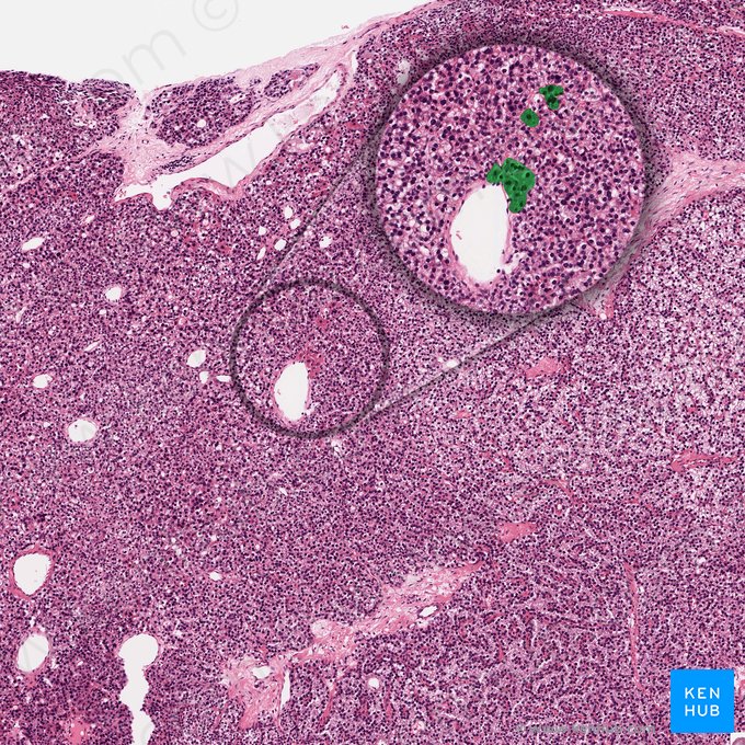 Célula oxifílica (Parathyrocytus oxyphilicus); Imagem: 