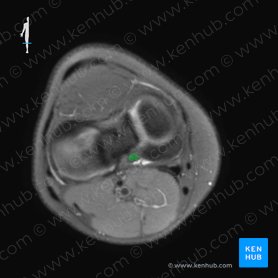 Posterior cruciate ligament (Ligamentum cruciatum posterius); Image: 