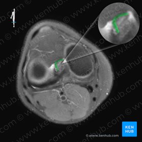 Anterior cruciate ligament (Ligamentum cruciatum anterius); Image: 