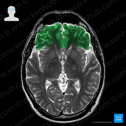 Lobus frontalis (Stirnlappen); Bild: 