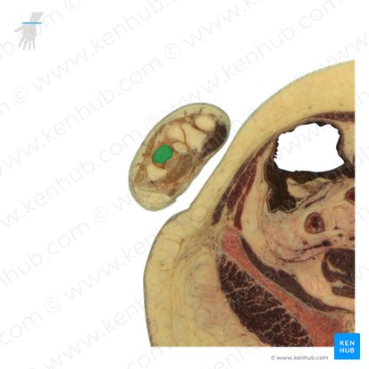 Capitate bone (Os capitatum); Image: National Library of Medicine