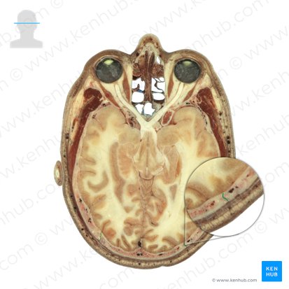 Lambdoid suture (Sutura lambdoidea); Image: National Library of Medicine