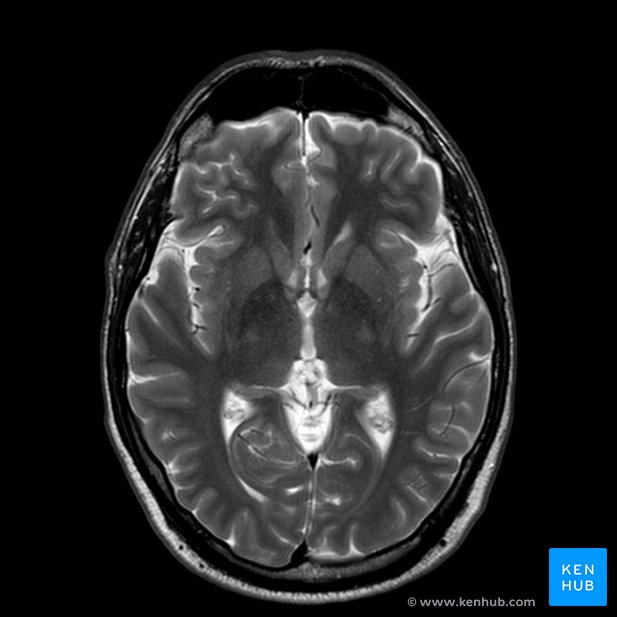 Normales Gehirn-MRT