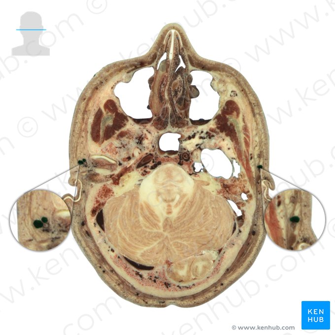 Vena temporalis superficialis (Oberflächliche Schläfenvene); Bild: National Library of Medicine