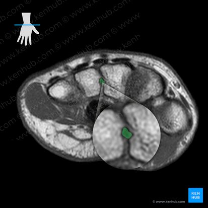 Ligamenta metacarpea interossea (Zwischenknochenbänder der Mittelhand); Bild: 